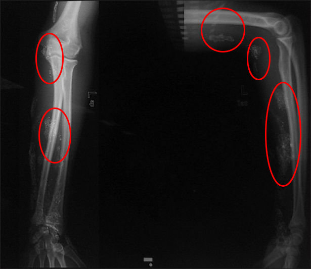 X-Ray에 촬영된 (수은이 주입된) 아이의 팔. NCBI
