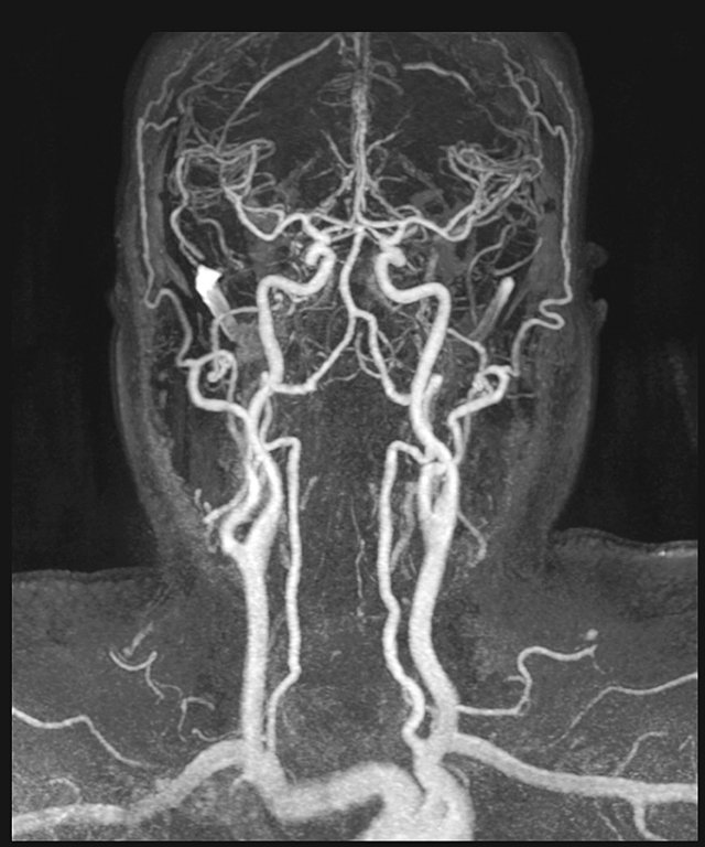 MRA 정상 혈관 사진.