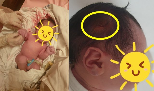 제왕절개 수술로 태어난 신생아의 오른쪽 머리에 칼 자국이 나있어 부모가 울분을 터뜨렸다. (온라인 커뮤니티 갈무리) © 뉴스1