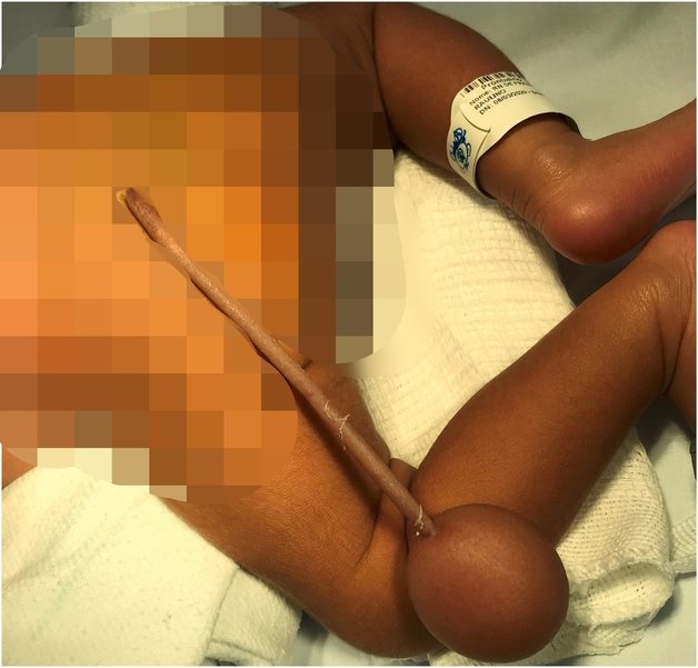 지난 1월 브라질에서 태어난 한 신생아가 엉덩이에 꼬리와 공을 달고 태어났다. (더선 갈무리) © 뉴스1