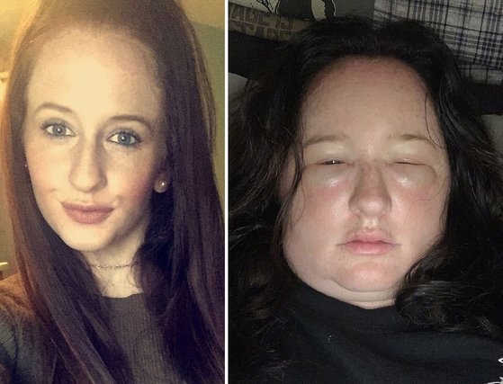 미국 뉴욕에 거주하는 켈리(26)가 염색약 부작용으로 부어버린 얼굴을 공개했다. (트위터 갈무리) © 뉴스1
