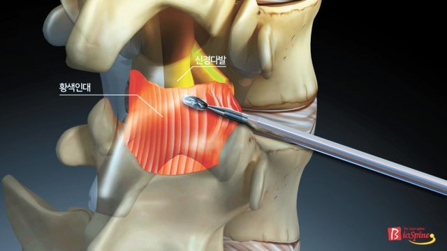 추간공확장술은 한미일의 특허받은 특수 키트를 이용해 신경을 압박하는 황색인대를 절제하고 염증을 유발하는 물질을 배출하는 공간을 확보해 치료한다. 서울 광혜병원 제공