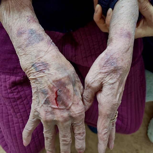 노인주간보호센터에서 집단폭행을 당한 80대 노인의 모습. 온라인 커뮤니티 갈무리