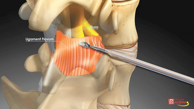 척추는 거미줄처럼 복잡한 구조… 추간공확장술 후 치료 기간-예후 달라”｜동아일보