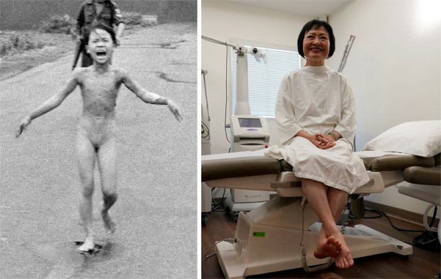 1972년 네이팜탄 폭격으로 전신에 화상을 입고 벌거벗은 채 도로를 달리고 있는 당시 9세의 판티낌푹 씨(왼쪽 사진). 그는 지난달 28일(현지 시간) 미국 플로리다주 마이애미의 한 피부과에서 마지막 화상 치료를 받았다. AP 자료사진·마이애미=AP 뉴시스