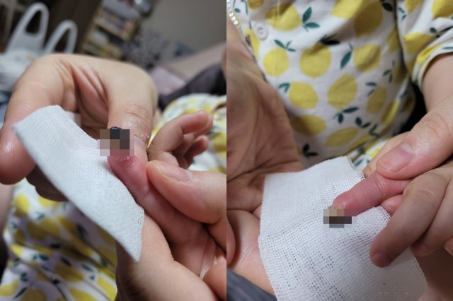 유모차 사고 후 봉합수술을 마친 아이 손가락. 커뮤니티 게시판