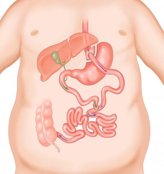 비만대사수술의 종류: 위우회술위를 식도 부근에서 작게 남기고 잘라 나머지 위와 분리한 후 소장과 연결하는 수술 방식이다. 섭취량 제한과 흡수 제한의 두 가지 효과를 얻을 수 있는 복합 수술 방식이다. 체중 감소 효과와 유지가 다른 수술에 비해 용이한 편이며 당뇨병 등 동반 질환의 개선 효과가 뚜렷해 제2형 당뇨병을 동반한 고도비만 환자에게 추천된다. 하지만 수술 난도가 위소매 절제술에 비해 상대적으로 높으며 수술 후 위 내시경검진이 어렵다는 단점이 있다.