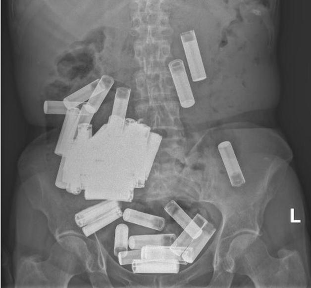 건전지 수십 개를 삼킨 여성의 복부 엑스레이 사진. (아이리시 인디펜던트)