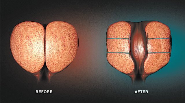 전립샘비대증으로 비대해진 전립샘(왼쪽)과 유로리프트를 통해 비대해진 전립샘을 묶은 모습.