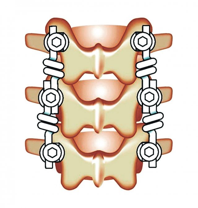 Bioflex 스크루 헤드에 2개의 로드가 결합될 수 있는 구조로 인해 분절별 연결 방식이 가능함을 보여주는 모식도.