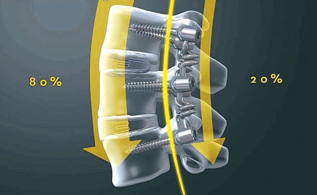 전방부에 척추 유합용 케이지와 후방부에 Bioflex를 병용할 경우 척추의 전방부와 후방부의 하중 분배 비율이 정상에 가까운 8 대 2 비율로 나타남을 표현한 모식도. 서울 광혜병원 제공