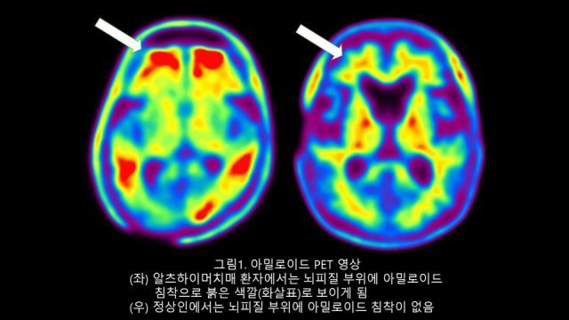 왼쪽은 알츠하이머 치매 환자의 아밀로이드 PET영상. 뇌피질 부위에 아밀로이드β 침착으로 붉은 색(화살표)로 보인다. 정상인은 뇌피질 부위에 아밀로이드β 침착이 없다(오른쪽). 동아일보 DB