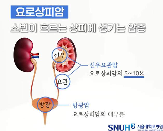 신우요관암 설명(서울대병원 제공)