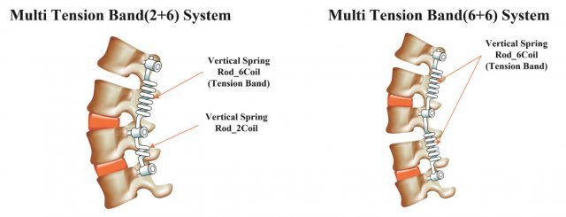 다분절 척추 변형에 활용되는 텐션 밴드 시스템. 서울 광혜병원 제공