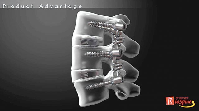 척추의 전방부 추체 사이에 ‘척추 유합용 케이지’, 척추의 후방부에 ‘Bioflex’가 삽입된 모식도. 서울 광혜병원 제공