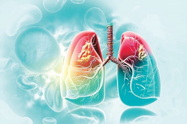 만성폐쇄성폐질환은 폐와 기관지에 만성적인 염증이 생겨 점점 기도가 좁아지고 폐기능이 망가지면서 호흡이 어려워지는 질병이다. 게티이미지코리아