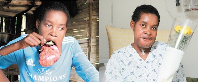 서울아산병원에서 혹 제거 수술을 받고 5일 귀국을 앞둔 마다가스카르인 플란지 씨의 수술 전(왼쪽)과 후 사진. 서울아산병원 제공