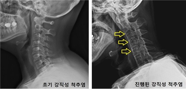 강직성 척추염 자료. 국민건강보험공단 제공