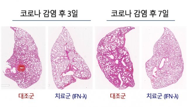 폐 조직분석 결과 서울대병원제공