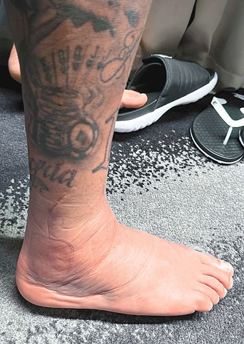 네이마르가 26일 인스타그램에 올린 자신의 오른쪽 발. 부상 여파로 발목이 퉁퉁 부어 있다. 사진 출처 네이마르 인스타그램