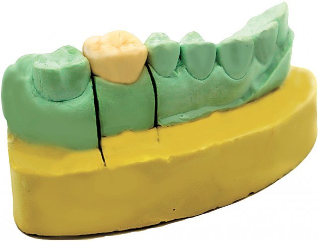 AI 자동설계와 원격출력 기술로 제작한 임시치아(Temporary Crown) 샘플. 큐브세븐틴 제공