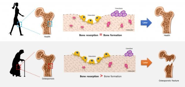 골다공증의 발병 과정. 뼈를 만드는 조골세포의 수가 뼈를 분해하는 파골세포의 수보다 적어지면 악화된다. 출처 = 큐제네틱스