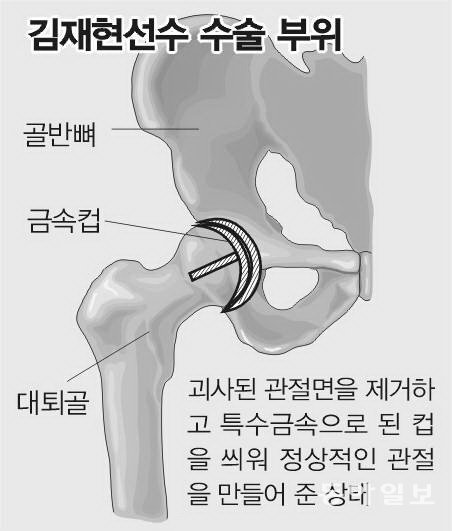 김재현 코디네이터 수술 과정을 설명한 당시 동아일보 그래픽