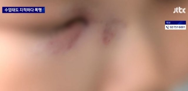 지난달 31일 경남 사천에서 한 학원 강사가 주먹을 휘둘러 중학생의 코뼈가 부러지고 코와 눈 주변에 멍이 들었다. JTBC 뉴스 방송화면 캡처