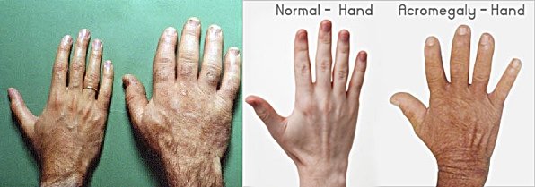 정상인  손(왼쪽  사진 왼쪽, 오른쪽  사진 왼쪽)과 말단비대증에 걸린 손. 사진 출처 현대아산병원, 메디인디아넷