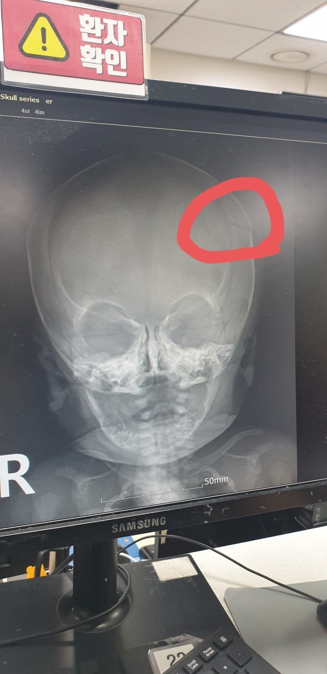 낙상사고를 당한 아기의 어머니가 온라인 커뮤니티에 올린 아기의 두개골 골절 사진.온라인 커뮤니티 네이트판 캡처