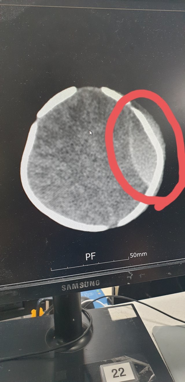 아기의 뇌출혈 증상을 확인할 수 있는 CT 촬영 사진.온라인 커뮤니티 네이트판 캡처