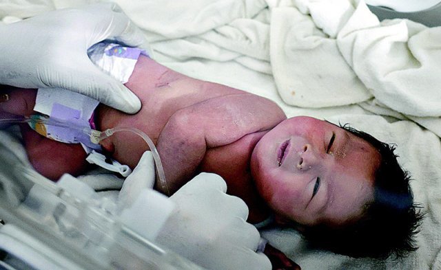 6일(현지 시간) 시리아 진디레스의 무너진 아파트 잔해 속에서 태어나 탯줄을 단 채 구조된 신생아가 7일 알레포의 소아병동에서 치료받고 있다. 알레포=AP 뉴시스