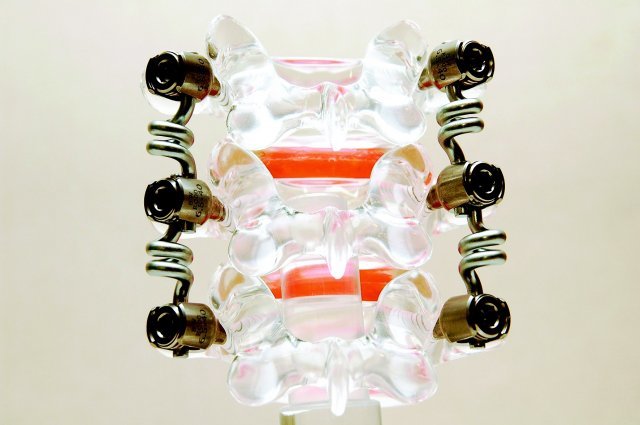 척추 모형에 삽입한 바이오플렉스 추간체고정재의 모습.