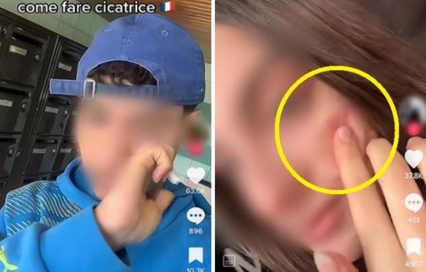 이탈리아 10대들 사이에서 유행 중인 ‘프렌치 흉터 챌린지’. 틱톡 영상 캡처
