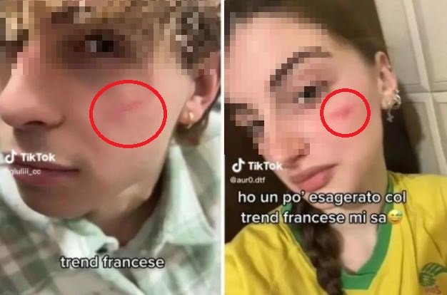 이탈리아 10대들 사이에서 유행 중인 ‘프렌치 흉터 챌린지’. 틱톡 영상 캡처