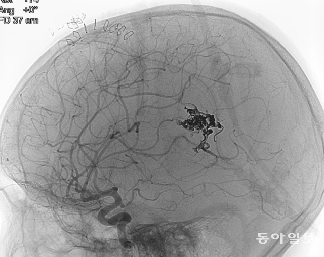 아주대병원에 도착해 찍은 준규의 뇌혈관 사진. 뇌혈관이 터져 피가 고인 곳이 검은 반점처럼 보인다.