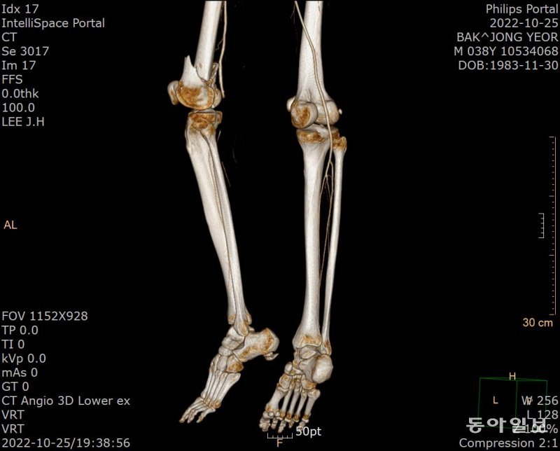 충북대병원에서 찍은 종열의 혈관 사진. 왼쪽 다리 혈관이 무릎 아래로는 끊어진 상태다.