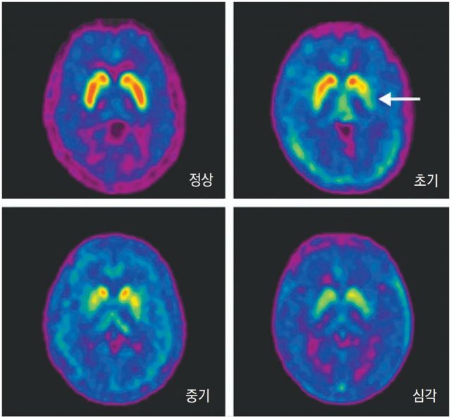 파킨슨병을 진단하는 도파체크주사는 신경 말단부 기능 소실을 측정해 이미지로 볼 수 있도록 해준다. 사진은 도파체크주사를 이용한 
진단 이미지. 정상부터 초기-중기-심각 단계 상태를 보여주는데 붉은색으로 보이는 도파민성 신경세포가 정상보다 줄어든 것을 확인할 수
 있다. 듀켐바이오 제공