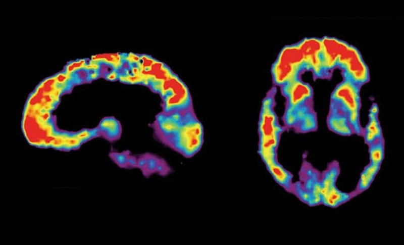 알츠하이머병 환자의 뇌를 양전자방출단층촬영(PET)으로 확인한 영상. 화살표로 표시된 부분(흰색 테두리 안쪽)은 알츠하이머병의 
발병 원인 중 하나로 지목되는 아밀로이드베타 단백질이 축적된 것을 의미한다. 미국국립보건원(NIH) 제공