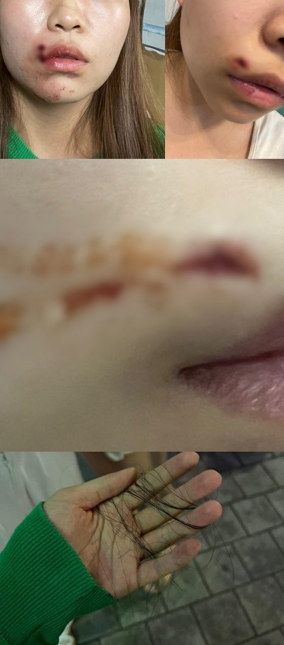 지난 10일 한 온라인 커뮤니티에는 ‘제 딸이 폭행을 당했습니다’란 글과 함께 일방적인 피해를 주장하는 사진이 올랐다.(보배드림 갈무리)/뉴스1