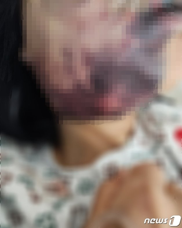 지난 4월17일 부산 동구 초량동 노래주점에서 폭행을 당한 업주 B씨가 얼굴을 다친 모습.(B씨 측 가족 제공)