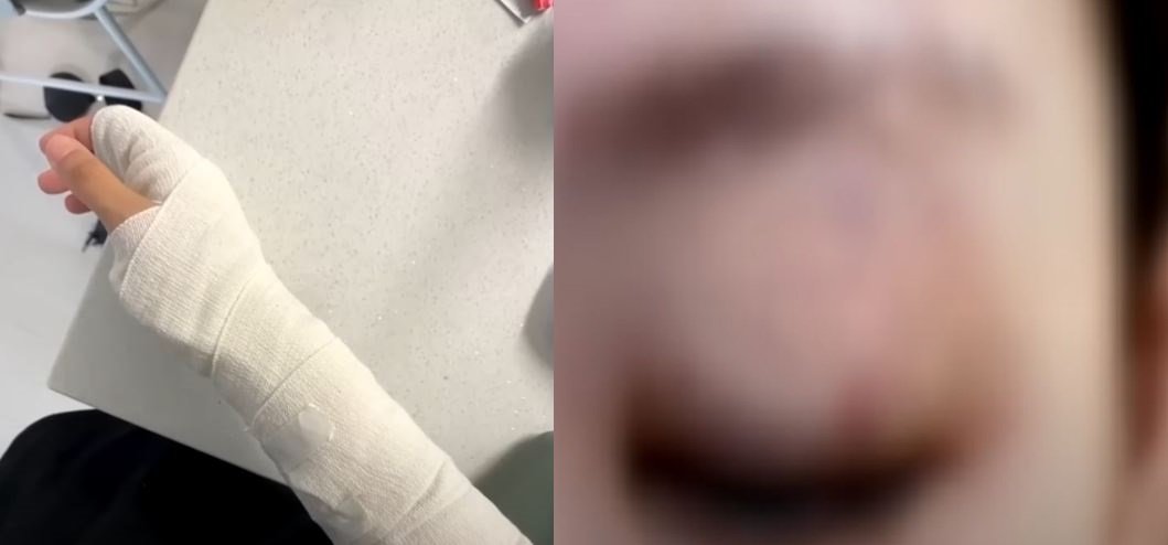 초등학교 6학년 학생으로부터 폭행을 당해 전치 3주를 진단받은 여교사의 상태. JTBC News 유튜브 캡처