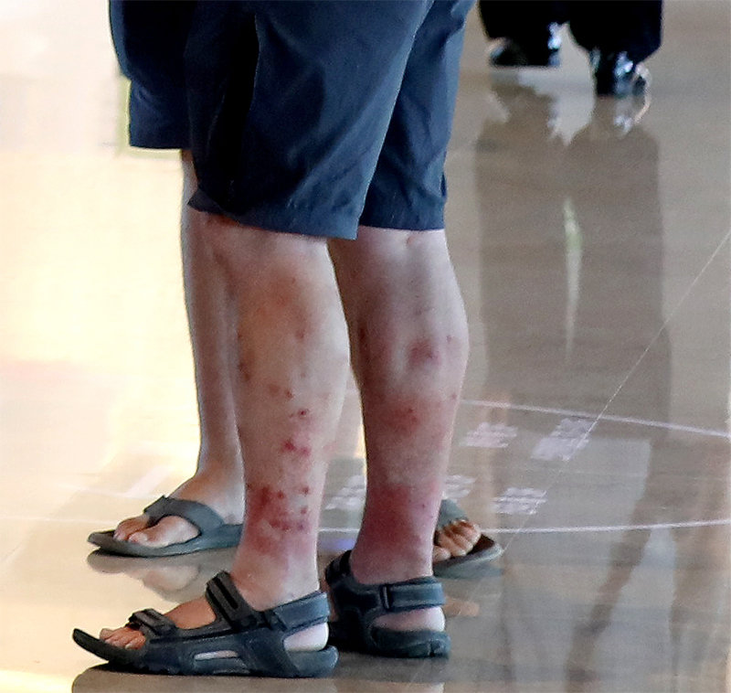 벌레 물린 자국 6일 서울 용산구의 한 호텔 로비에 도착한 영국 스카우트 관계자의 다리에 벌레에 물린 자국이 선명하게 남아 있다. 뉴스1
