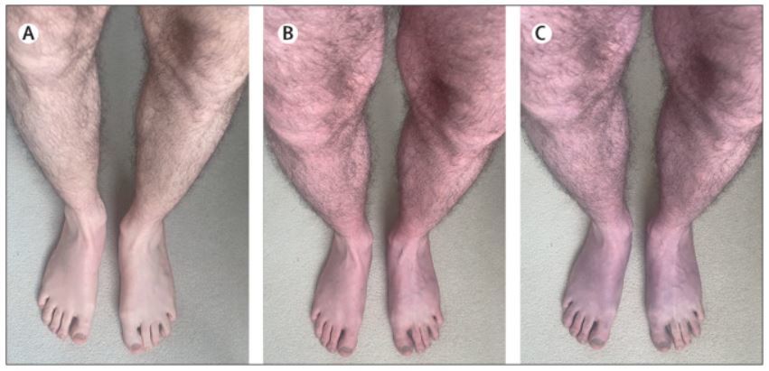 ‘푸른 다리 증상’(blue legs symptom)을 겪는 환자의 다리. (왼쪽부터) 환자가 막 일어섰을 때, 일어선 지 2분이 지났을 때, 일어선 지 10분이 지났을 때의 모습. 란셋(The Lancet) 캡처