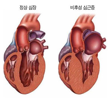 정상 심장(왼쪽)과 비후성 심근병증 모식도. 두꺼워진 심장벽이 특징이다.