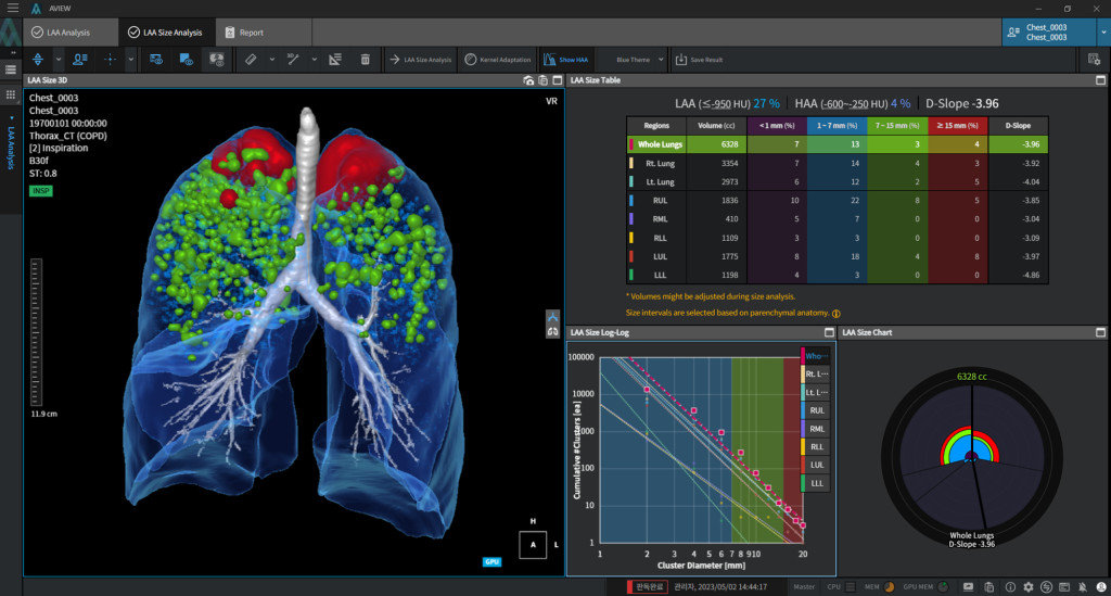 만성폐쇄성폐질환 자동분석 솔루션 ‘AVIEW COPD’의 자료 화면 / 출처=코어라인소프트