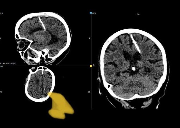 러시아의 80세 여성이 일평생 3㎝ 길이 바늘을 뇌에 꽂고 살아왔다는 사실이 알려지며 충격을 주고 있다.(텔레그램 갈무리).