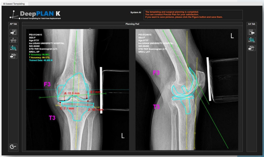 무릎 인공관절 전치환술을 돕는 카비랩의 ‘DeepPLAN K’ / 출처=카비랩