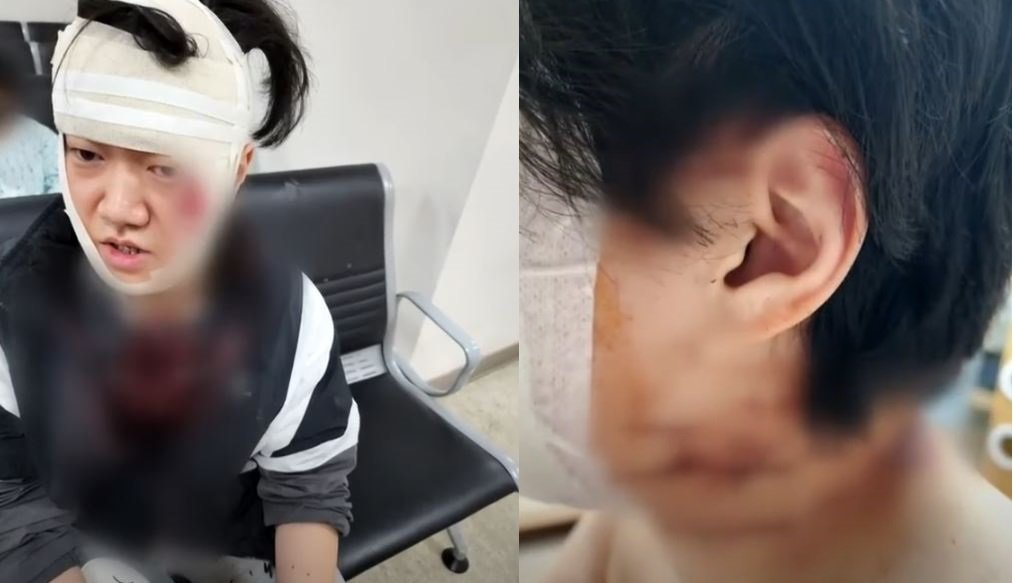 괴한을 경찰에 넘기고 병원치료를 받은 이수연 씨. JTBC News 유튜브 캡처