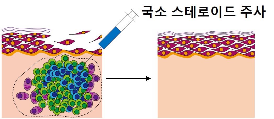 김종훈 교수는 국소 스테로이드 주사 치료를 통해 천포창 질환 증상을 개선시키는 치료 접근법을 제시했다.